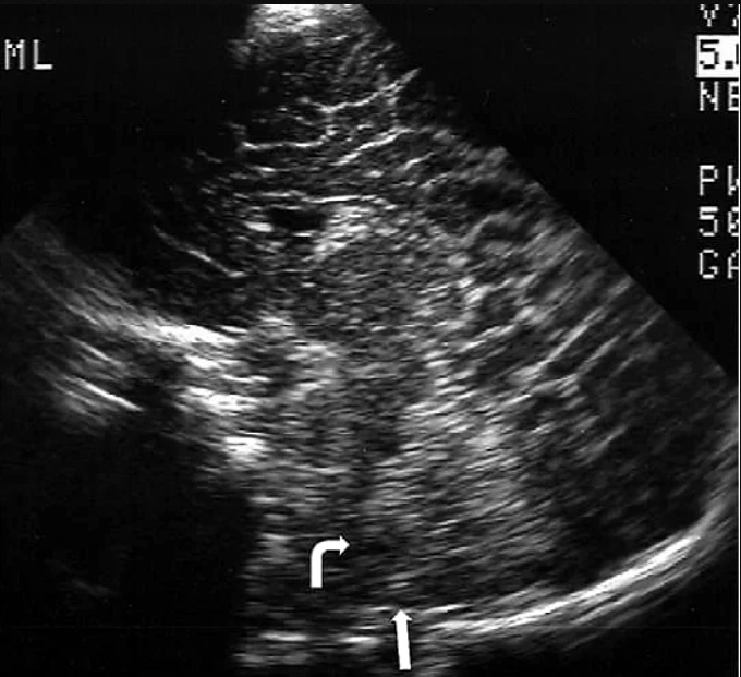 НСГ - нейросонографія НСГ - нейросонографія